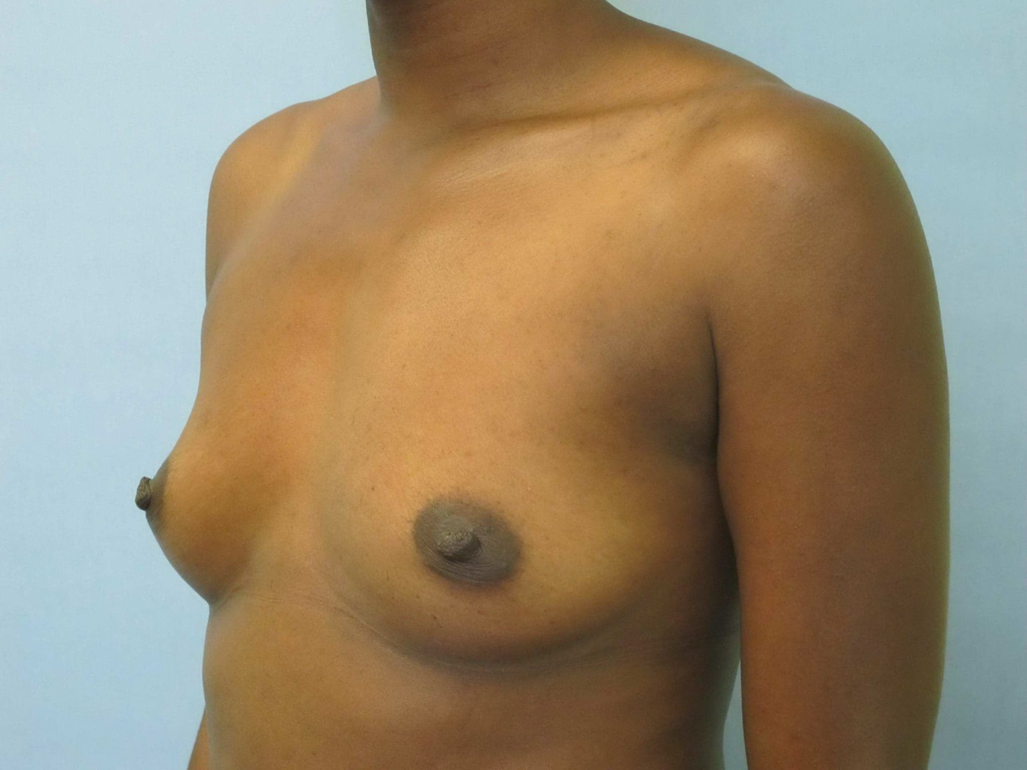 Breast Augmentation Patient Photo - Case 152 - before view-