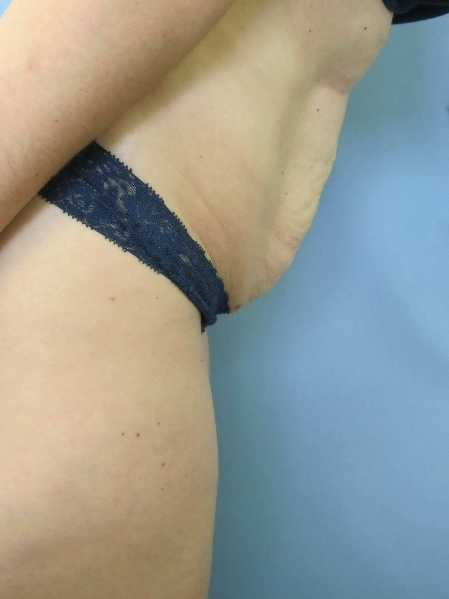 Liposuction Patient Photo - Case 115 - before view-1