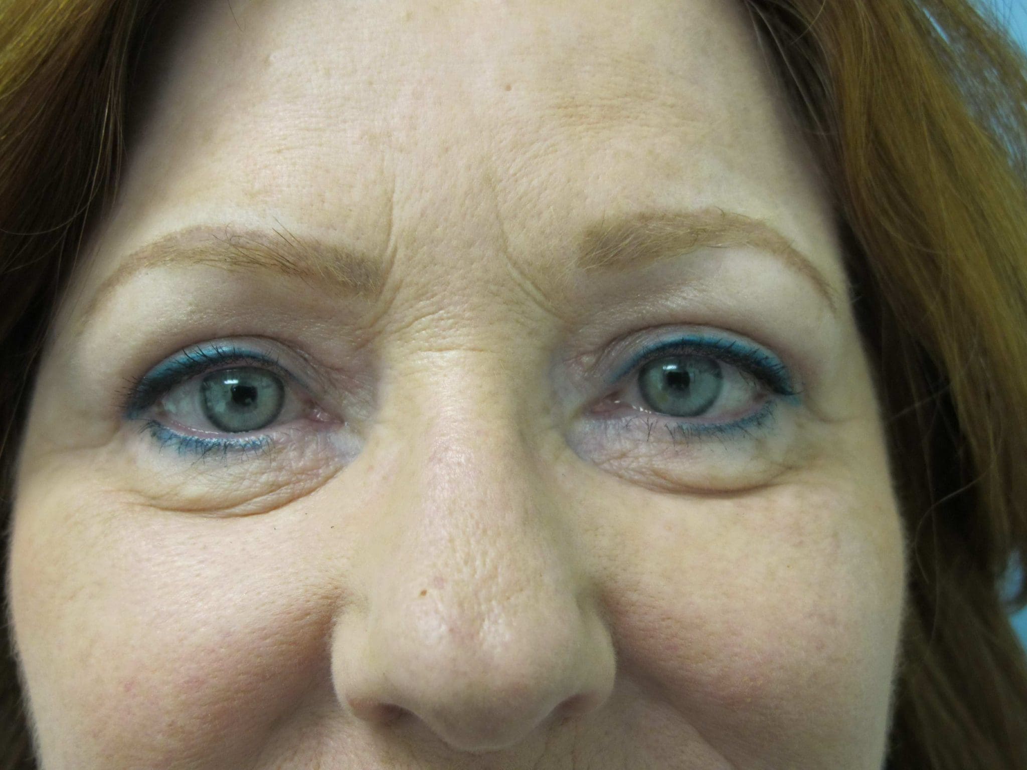 Eyelid Surgery Patient Photo - Case 116-3 - after view-1