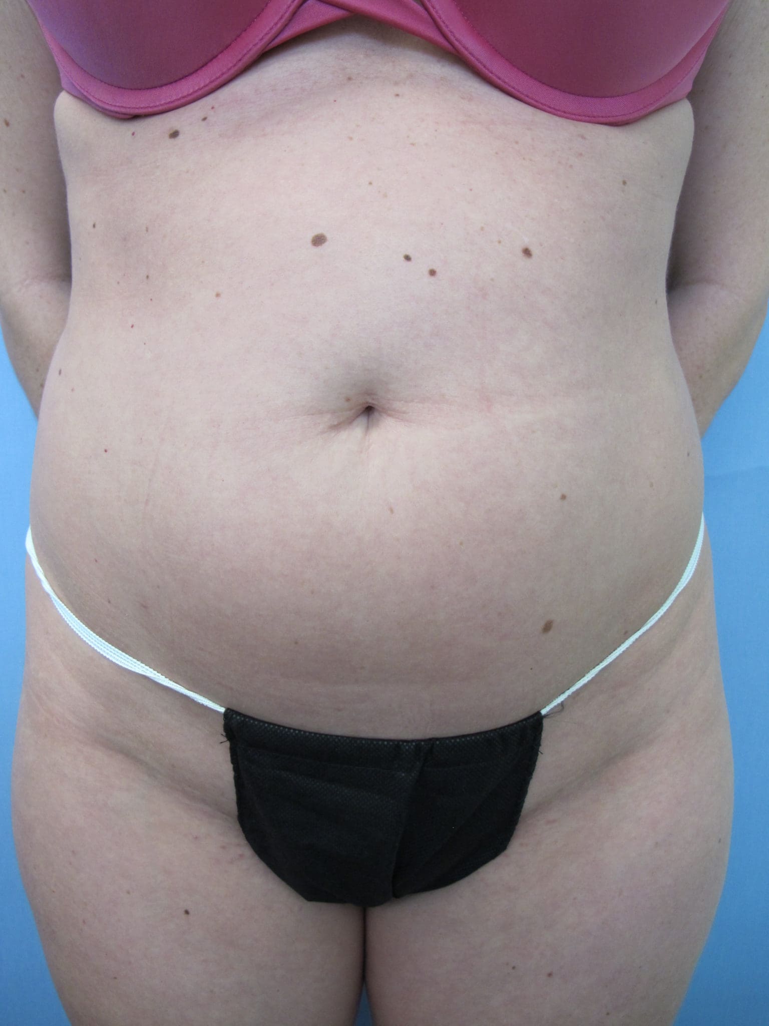 Liposuction Patient Photo - Case 81 - before view-