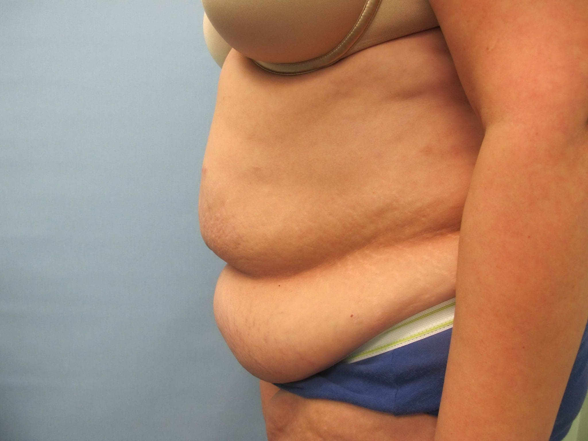 Liposuction Patient Photo - Case 127 - before view-1