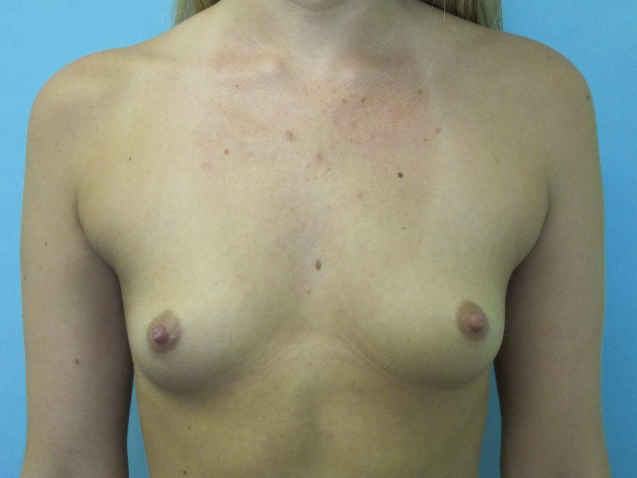 Breast Augmentation Patient Photo - Case 41 - before view-