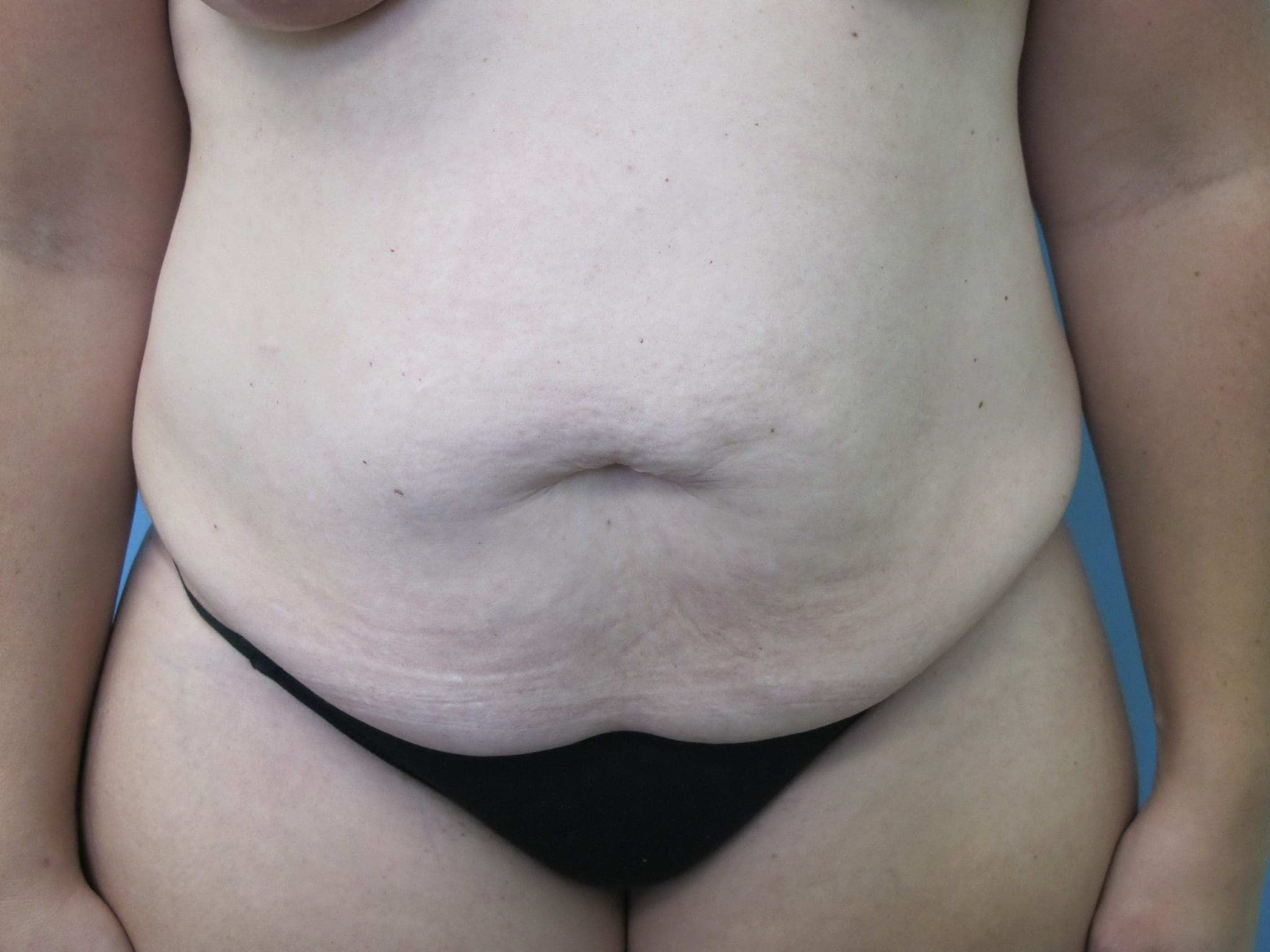 Tummy Tuck Patient Photo - Case 75 - before view-