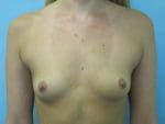 Breast Augmentation - Case 66 - Before