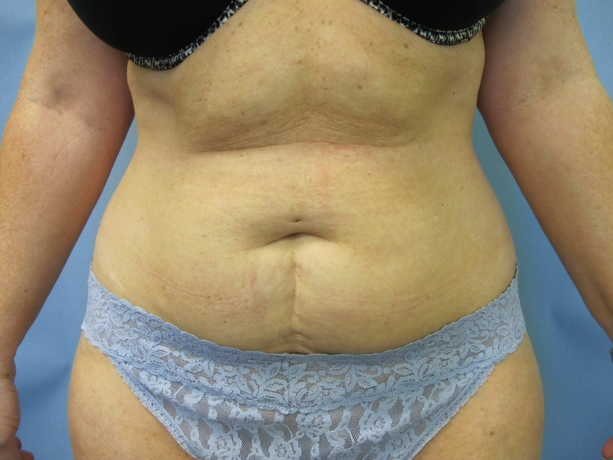 Tummy Tuck Patient Photo - Case 84 - before view-