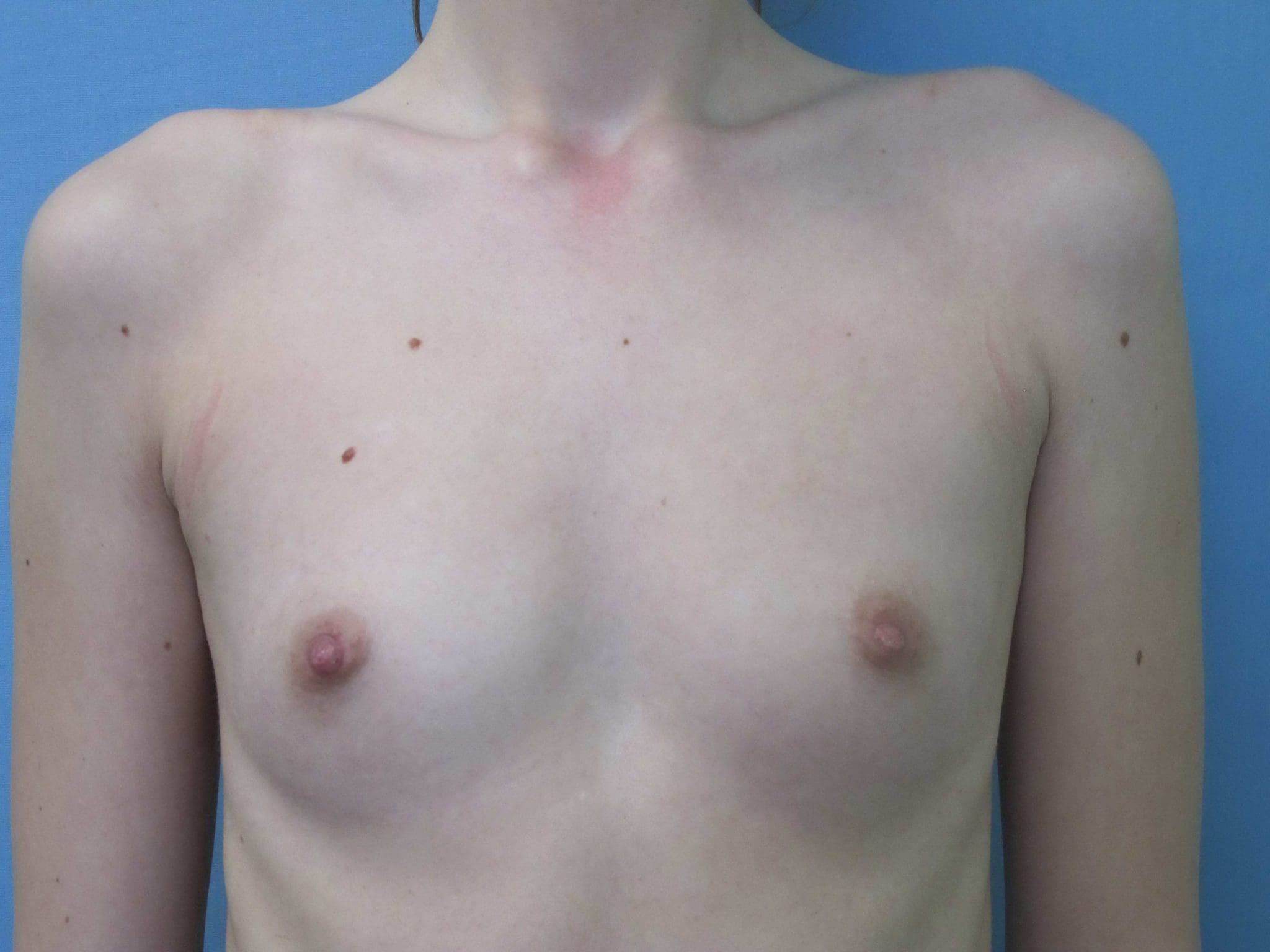 Breast Augmentation Patient Photo - Case 131 - before view-