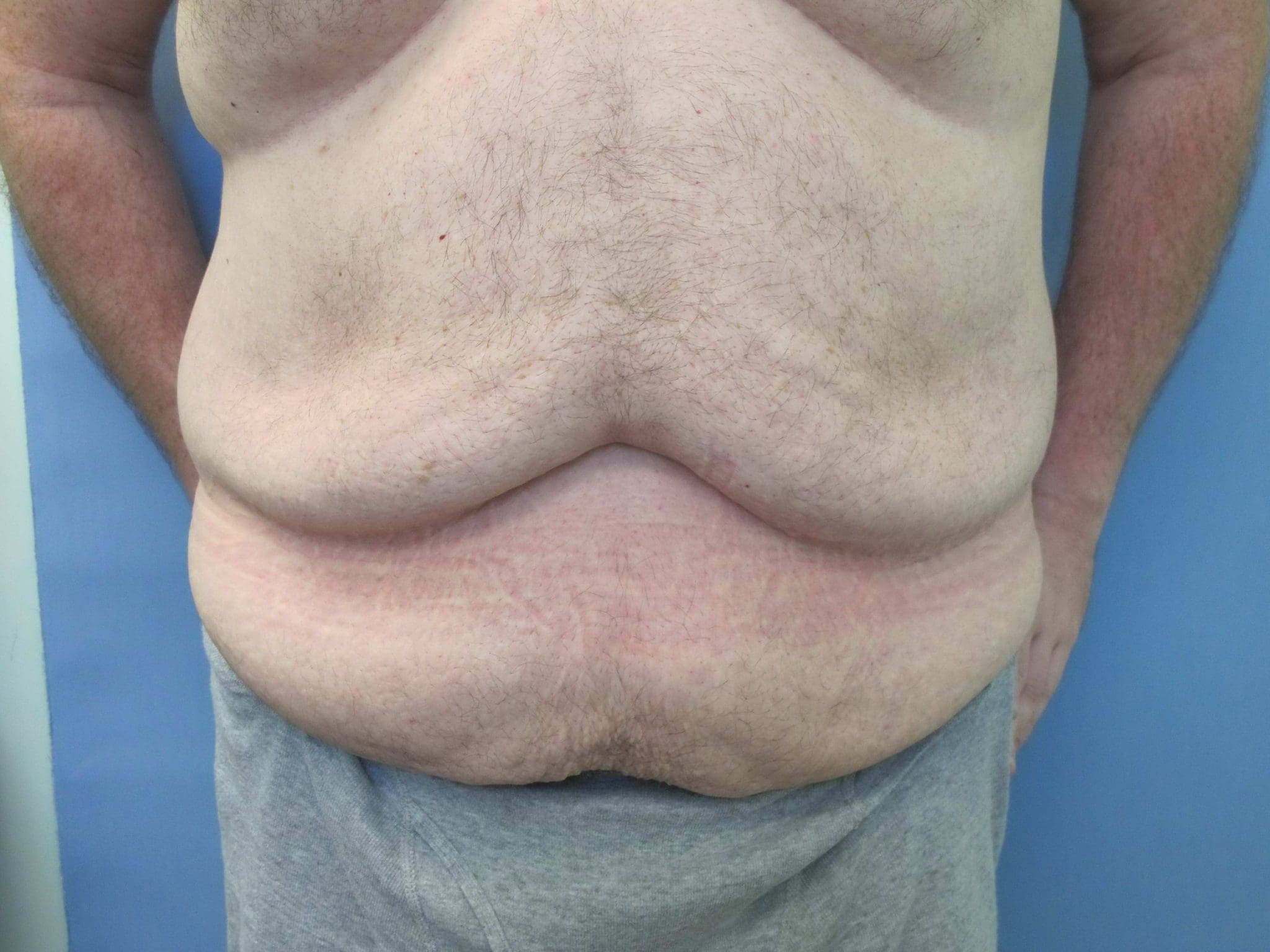 Liposuction Patient Photo - Case 76 - before view-