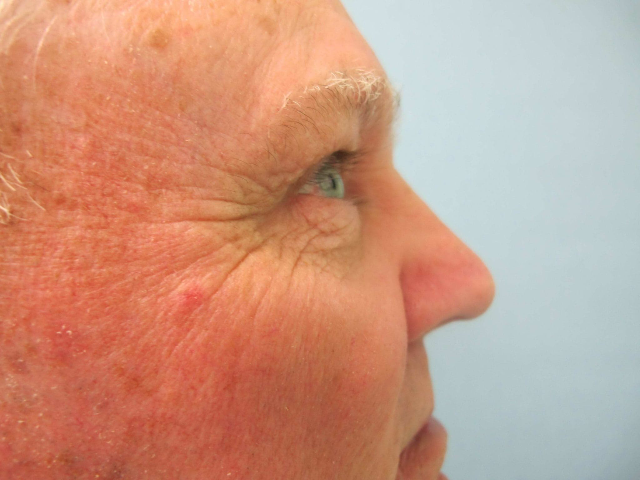 Eyelid Surgery Patient Photo - Case 126 - before view-1
