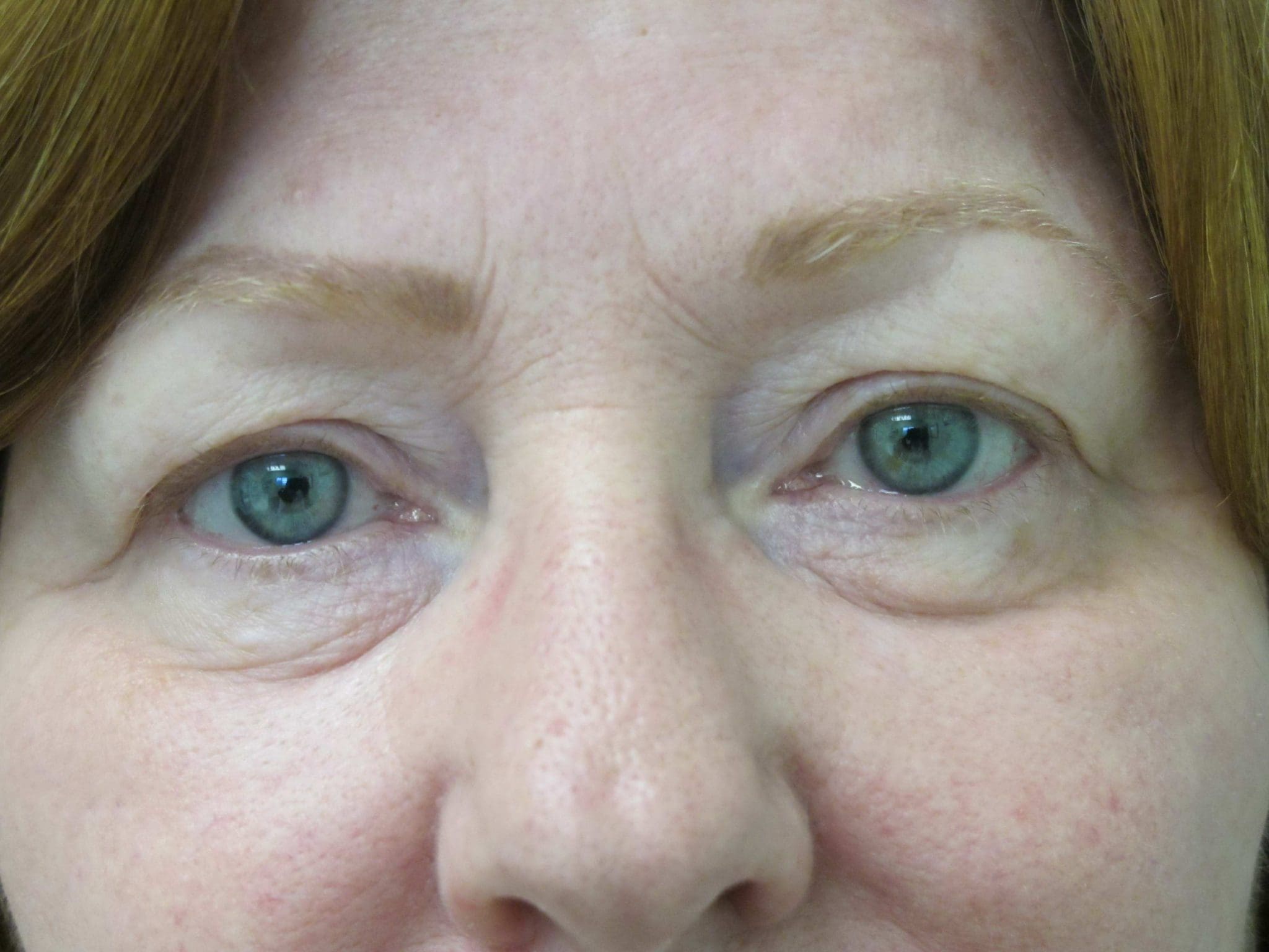 Eyelid Surgery Patient Photo - Case 116-3 - before view-1