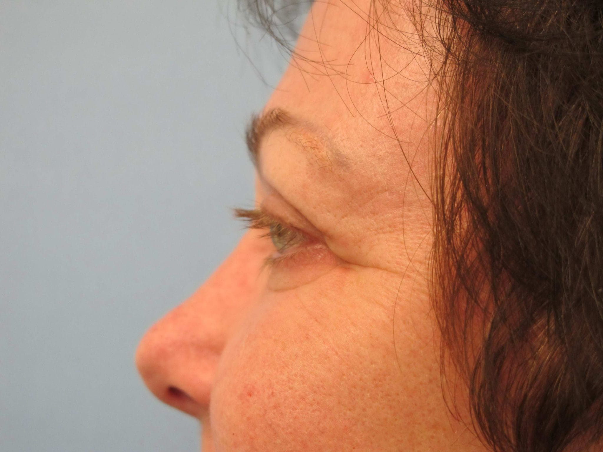 Eyelid Surgery Patient Photo - Case 121 - after view-1