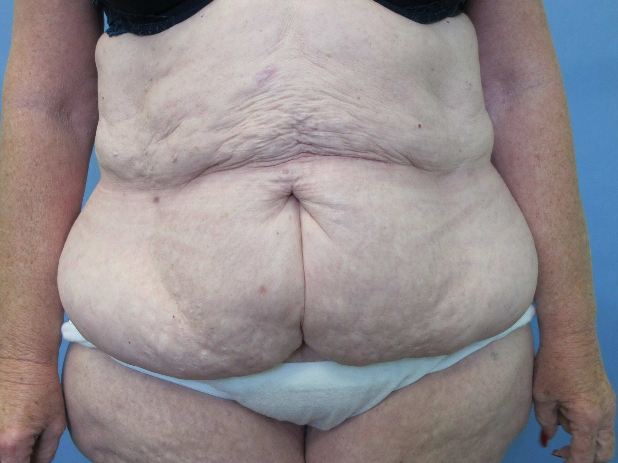 Liposuction Patient Photo - Case 78 - before view-