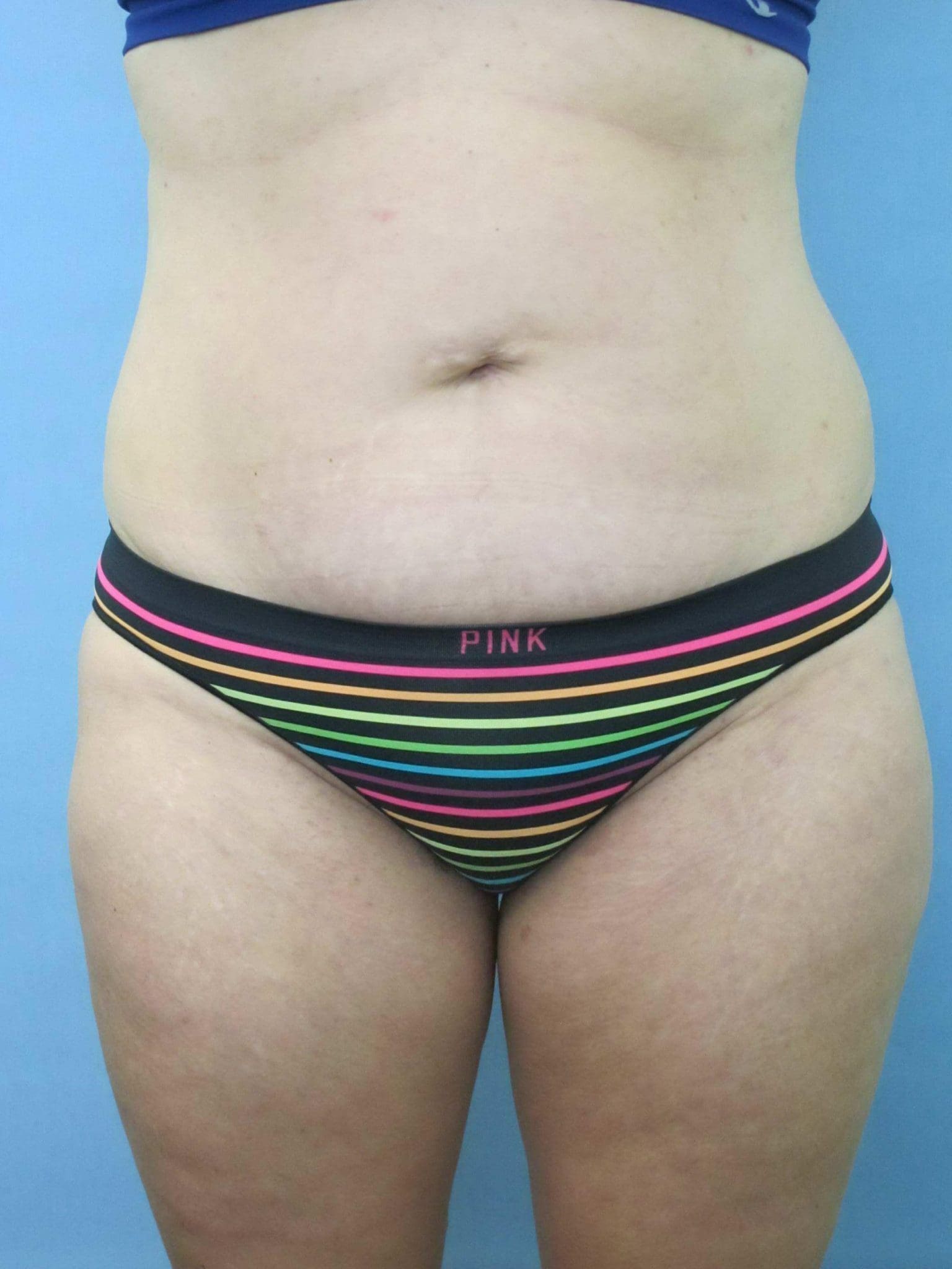 Liposuction Patient Photo - Case 154 - before view-
