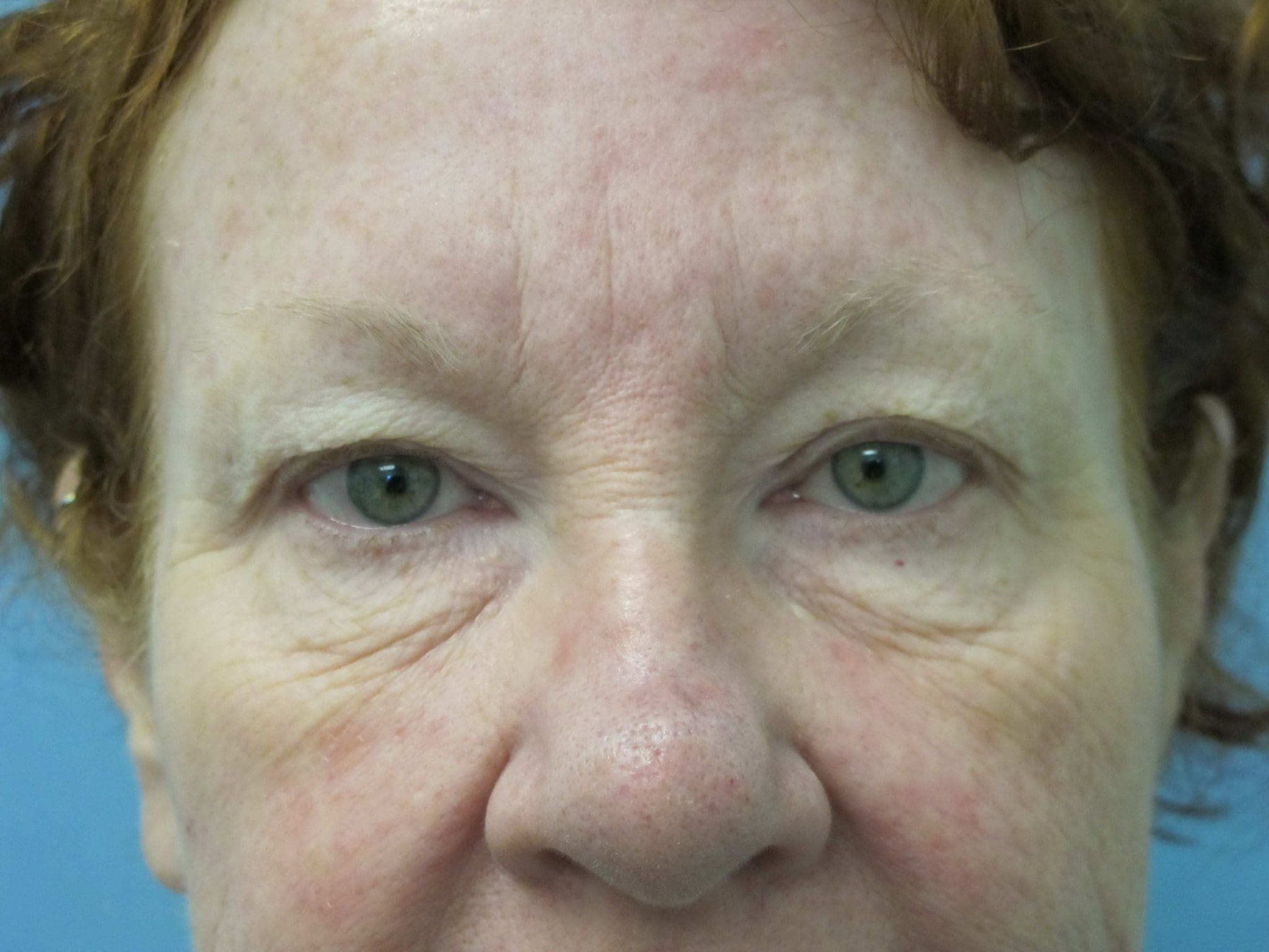 Eyelid Surgery Patient Photo - Case 53 - before view-