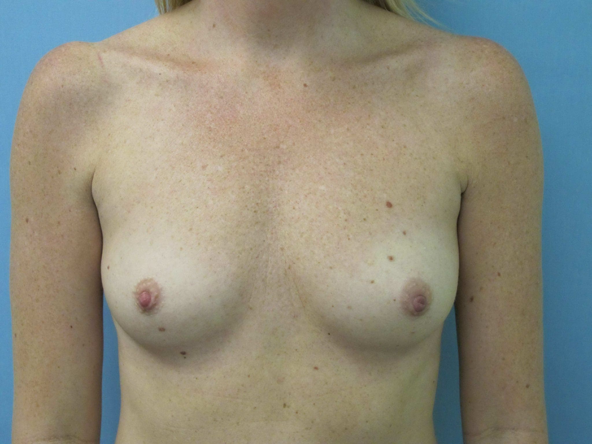 Breast Augmentation Patient Photo - Case 39 - before view-