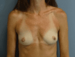 Breast Augmentation - Case 165 - Before