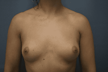 Breast Augmentation Patient Photo - Case 164 - before view-