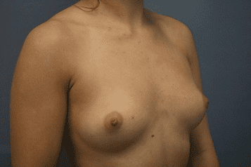 Breast Augmentation Patient Photo - Case 164 - before view-1