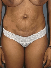 Tummy Tuck Patient Photo - Case 166 - before view-
