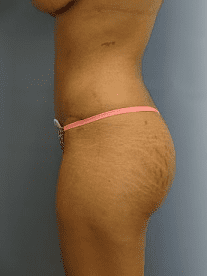 Tummy Tuck Patient Photo - Case 166 - after view-1