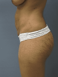 Tummy Tuck Patient Photo - Case 166 - before view-1