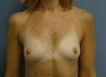 Breast Augmentation - Case 167 - Before