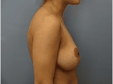 Breast Lift Patient Photo - Case 169 - after view-1