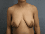 Breast Lift - Case 169 - Before