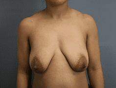 Breast Lift Patient Photo - Case 169 - before view-