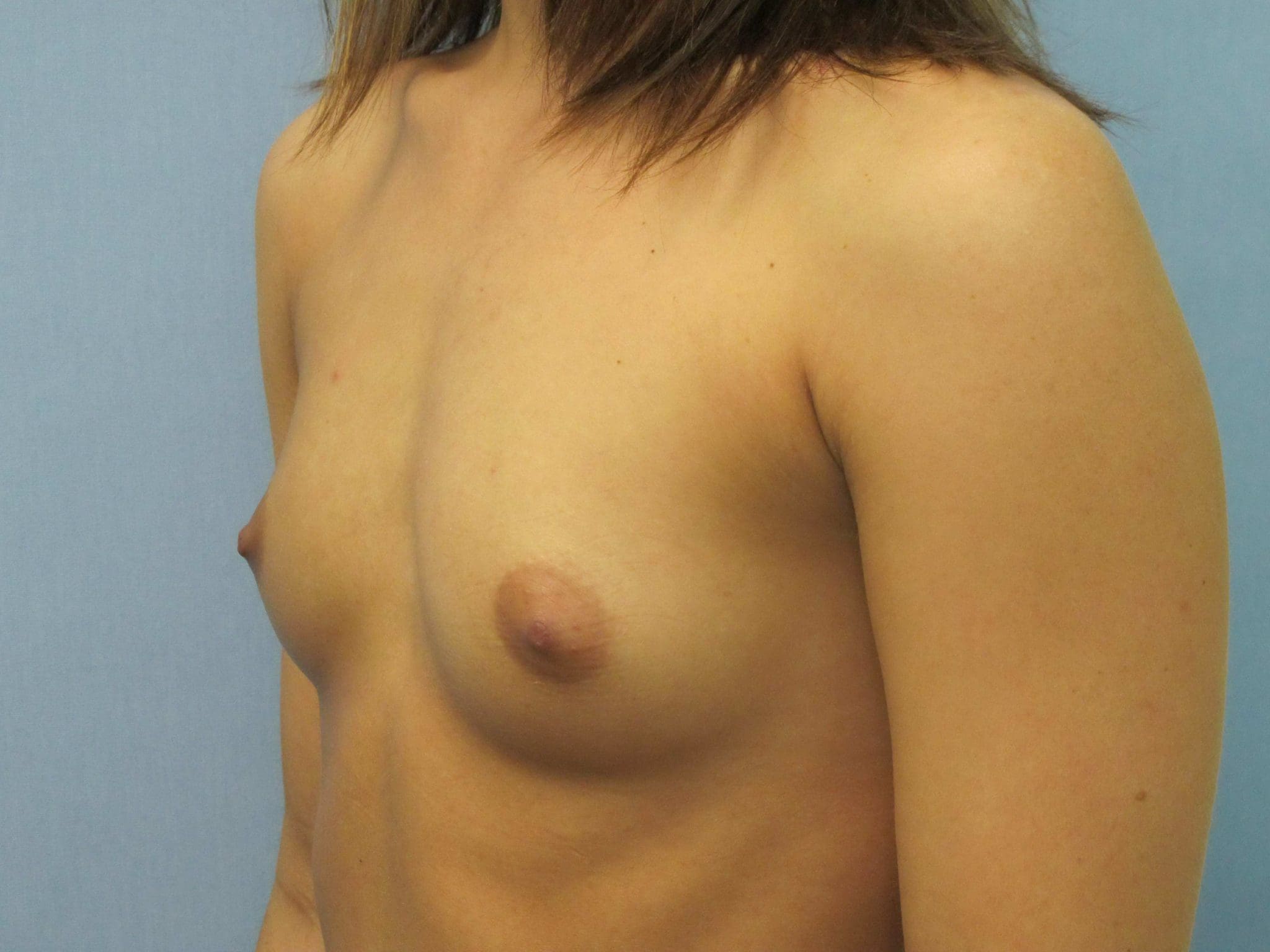 Breast Augmentation Patient Photo - Case 134 - before view-1