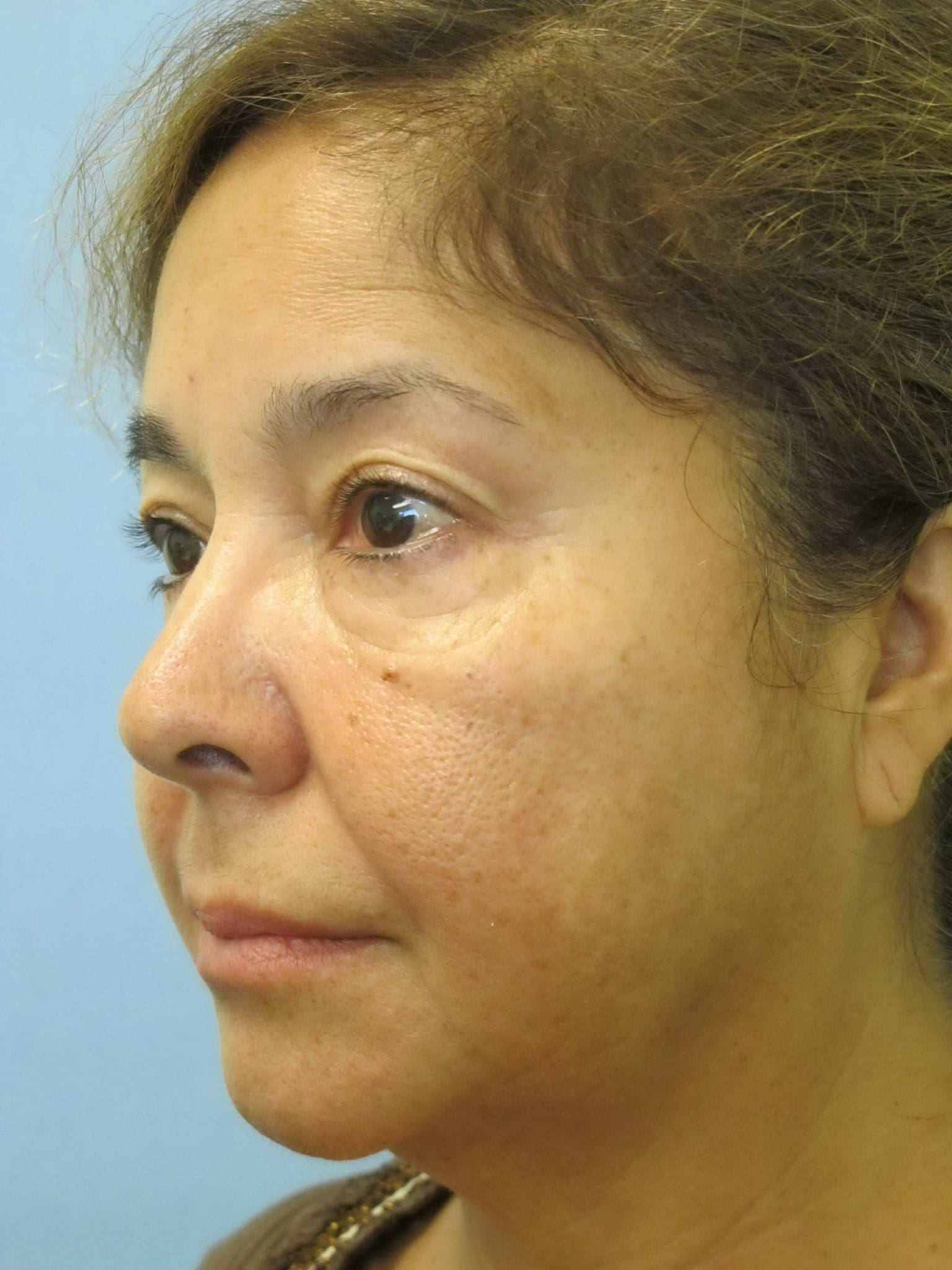 Liposuction Patient Photo - Case 137 - before view-