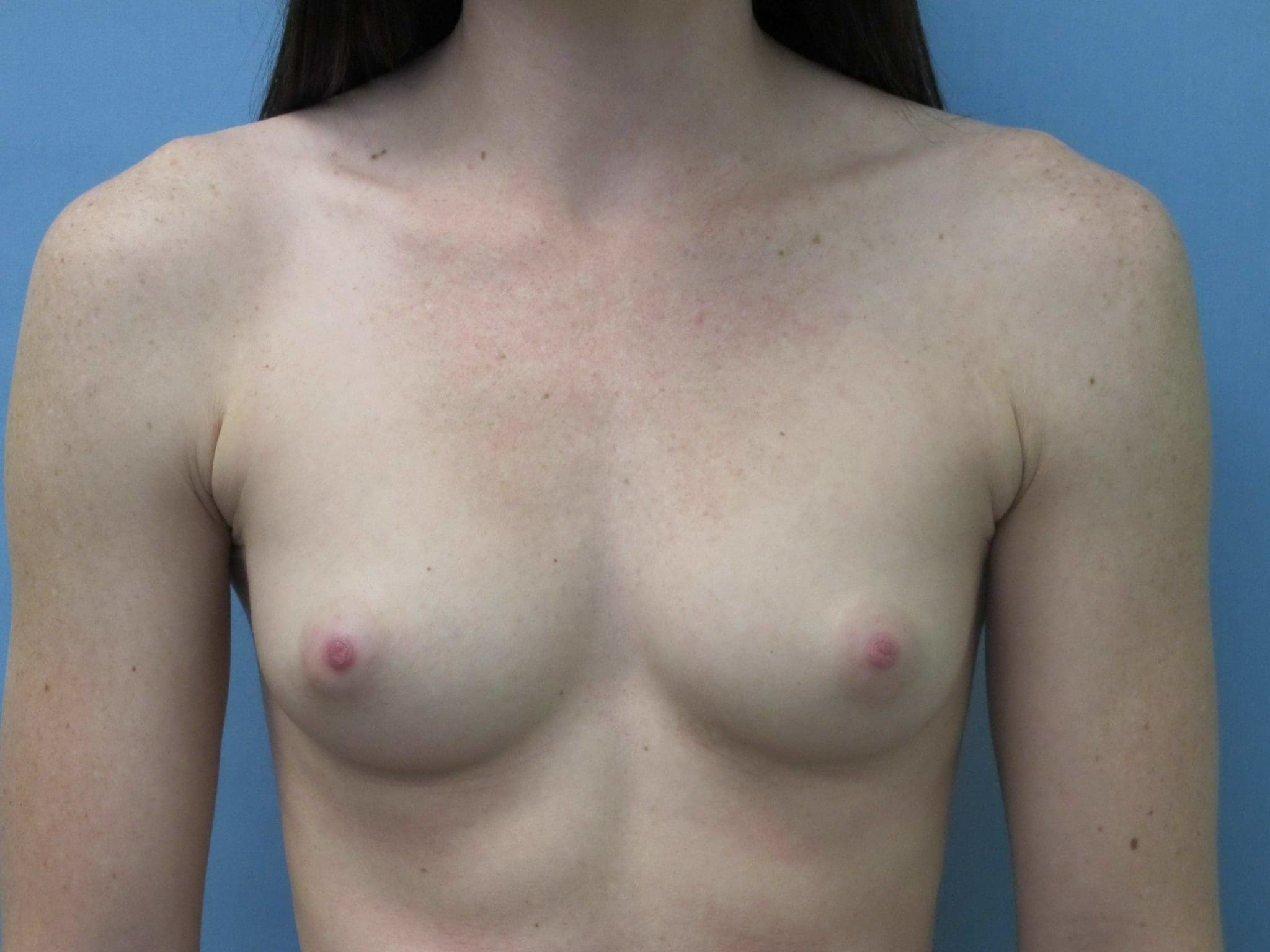 Breast Augmentation Patient Photo - Case 129 - before view-