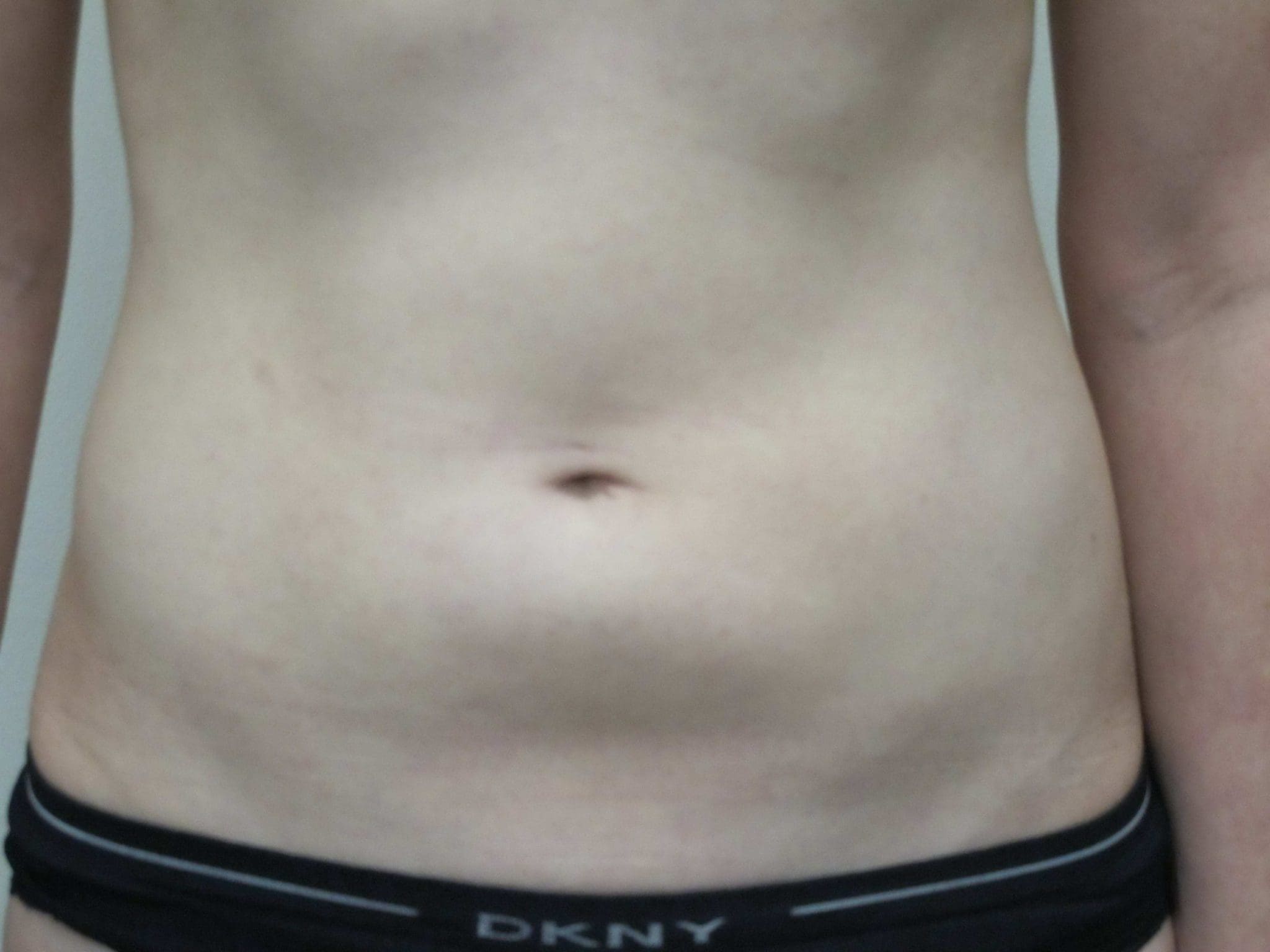Tummy Tuck Patient Photo - Case 146 - before view-