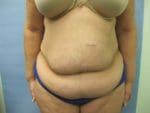 Liposuction - Case 127 - Before