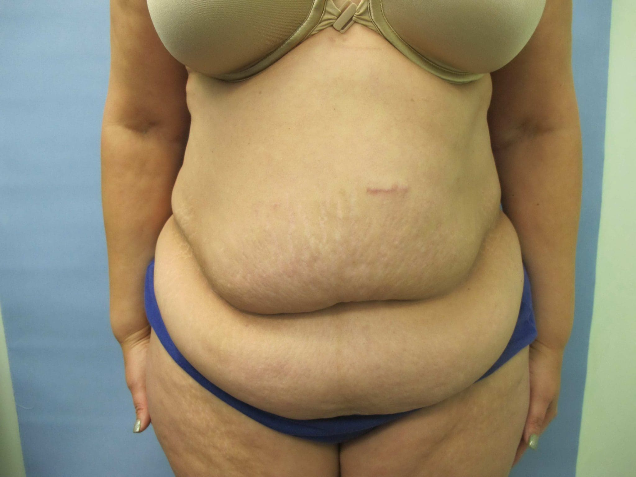 Liposuction Patient Photo - Case 127 - before view-