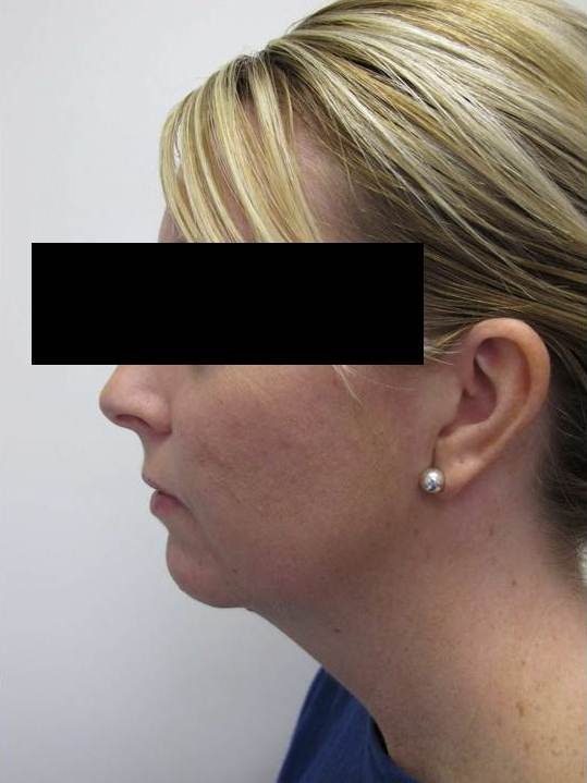 Fat Transfer Patient Photo - Case 57 - before view-