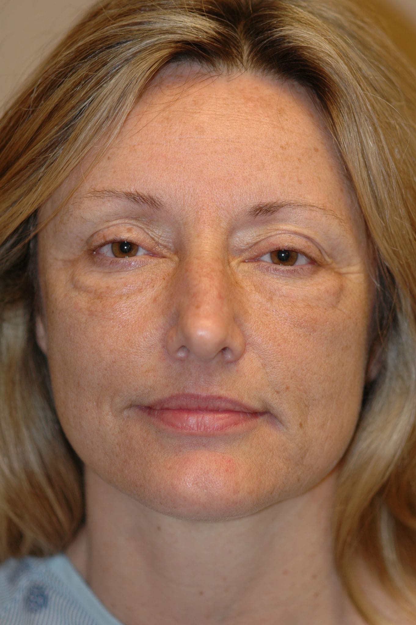 Eyelid Surgery Patient Photo - Case 104 - before view-