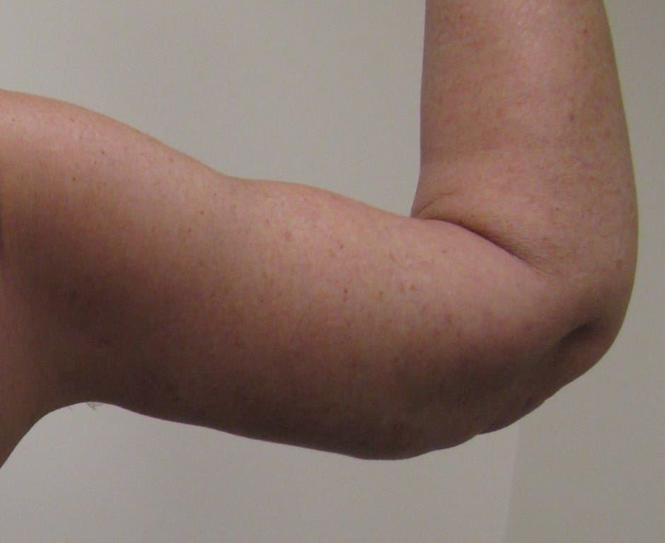 Arm Lift Patient Photo - Case 114 - after view