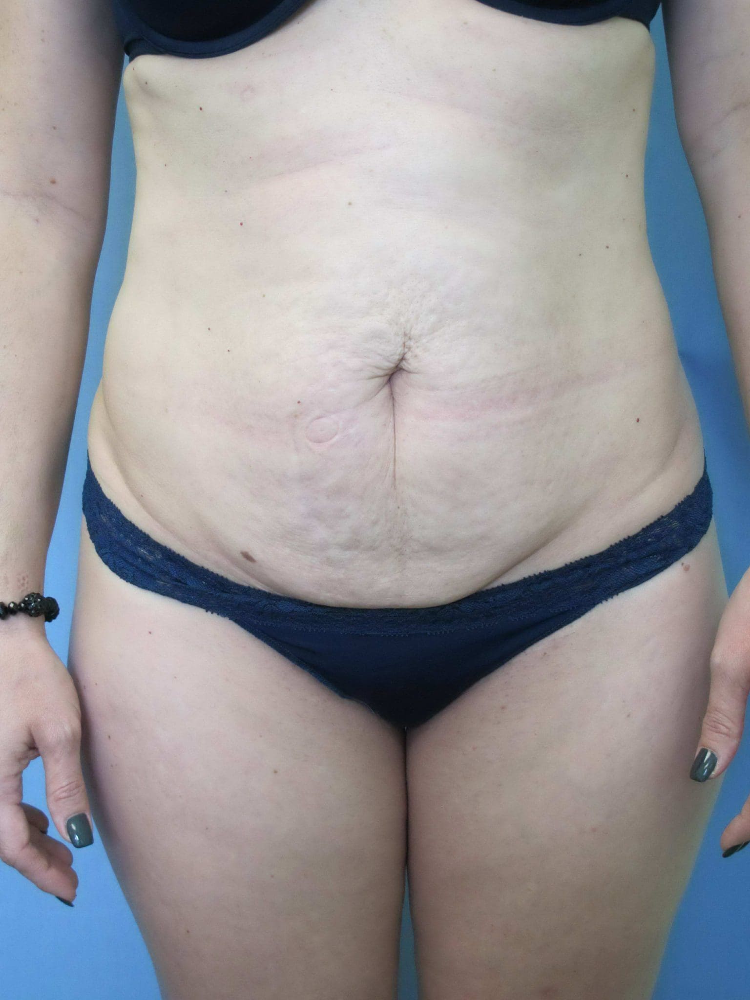Tummy Tuck Patient Photo - Case 115 - before view-