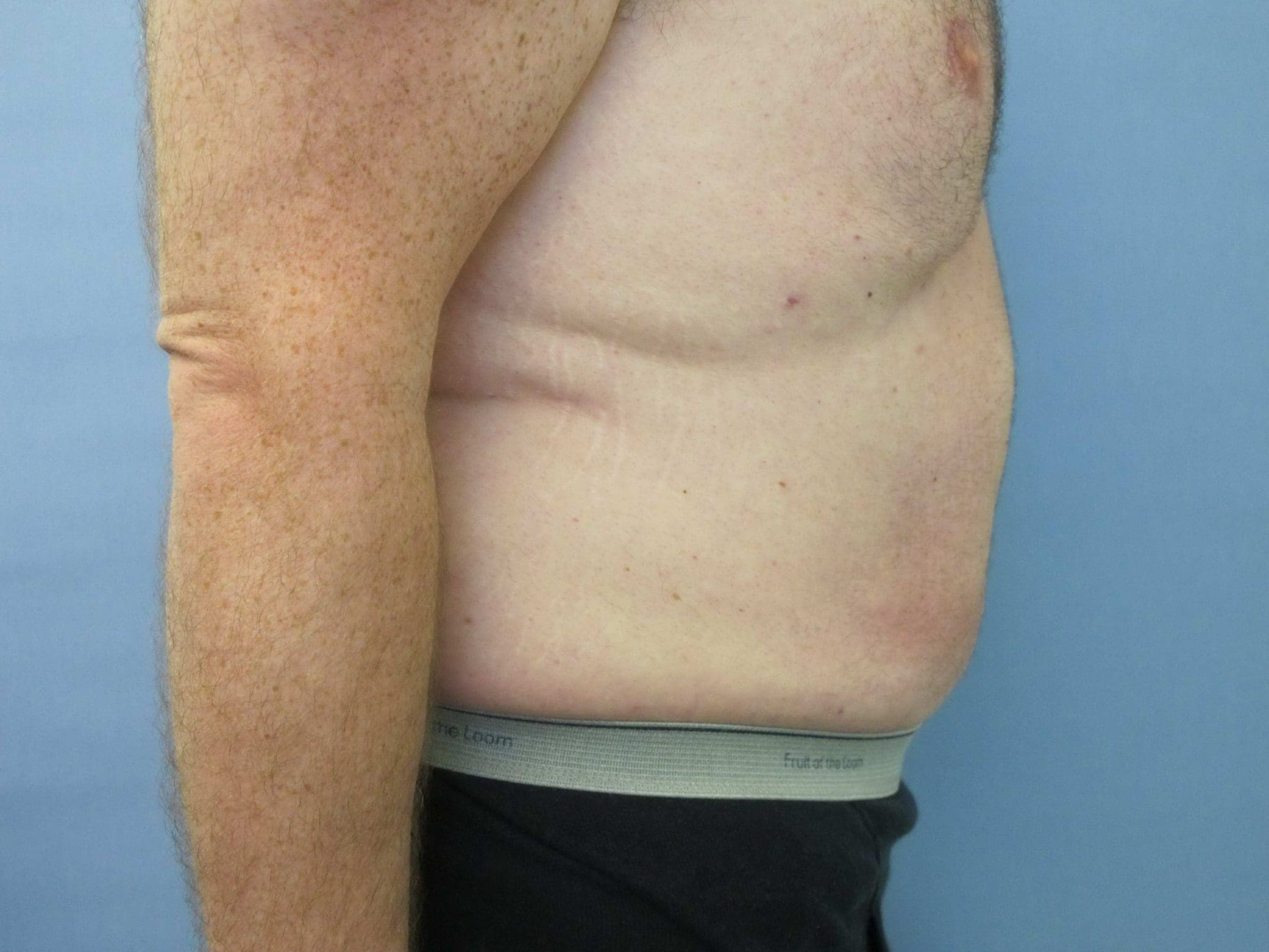 Liposuction Patient Photo - Case 76 - after view-1