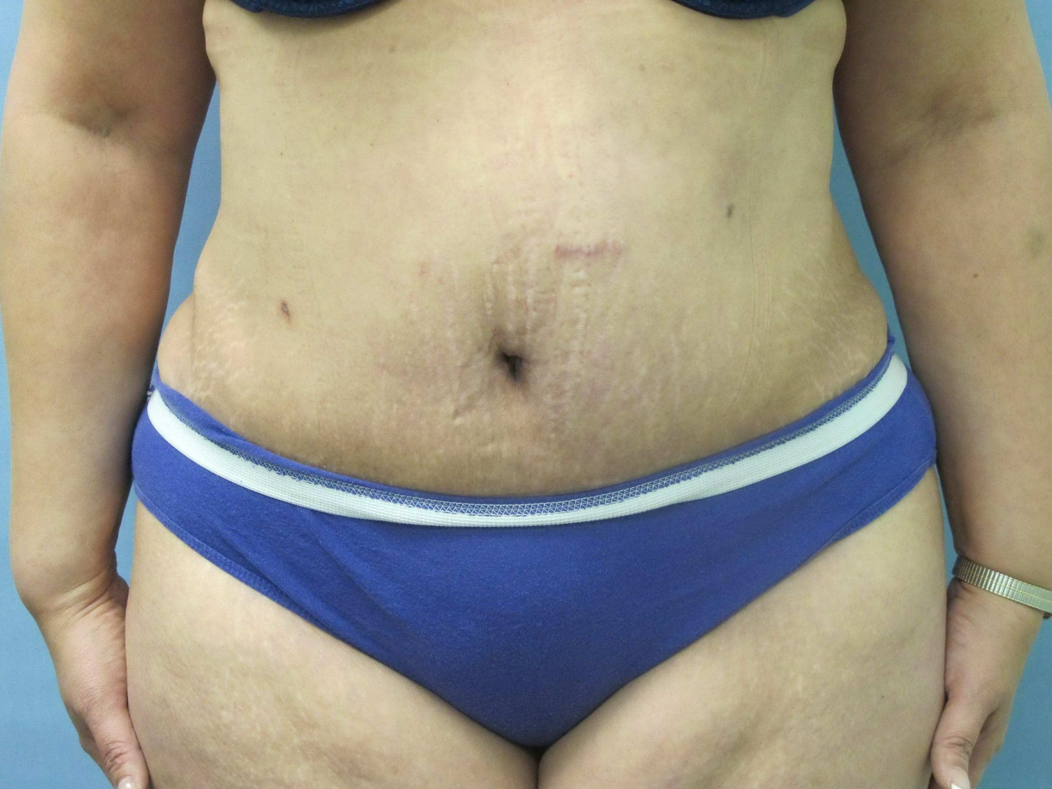 Tummy Tuck Patient Photo - Case 127 - after view