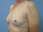 Breast Augmentation - Case 43 - Before