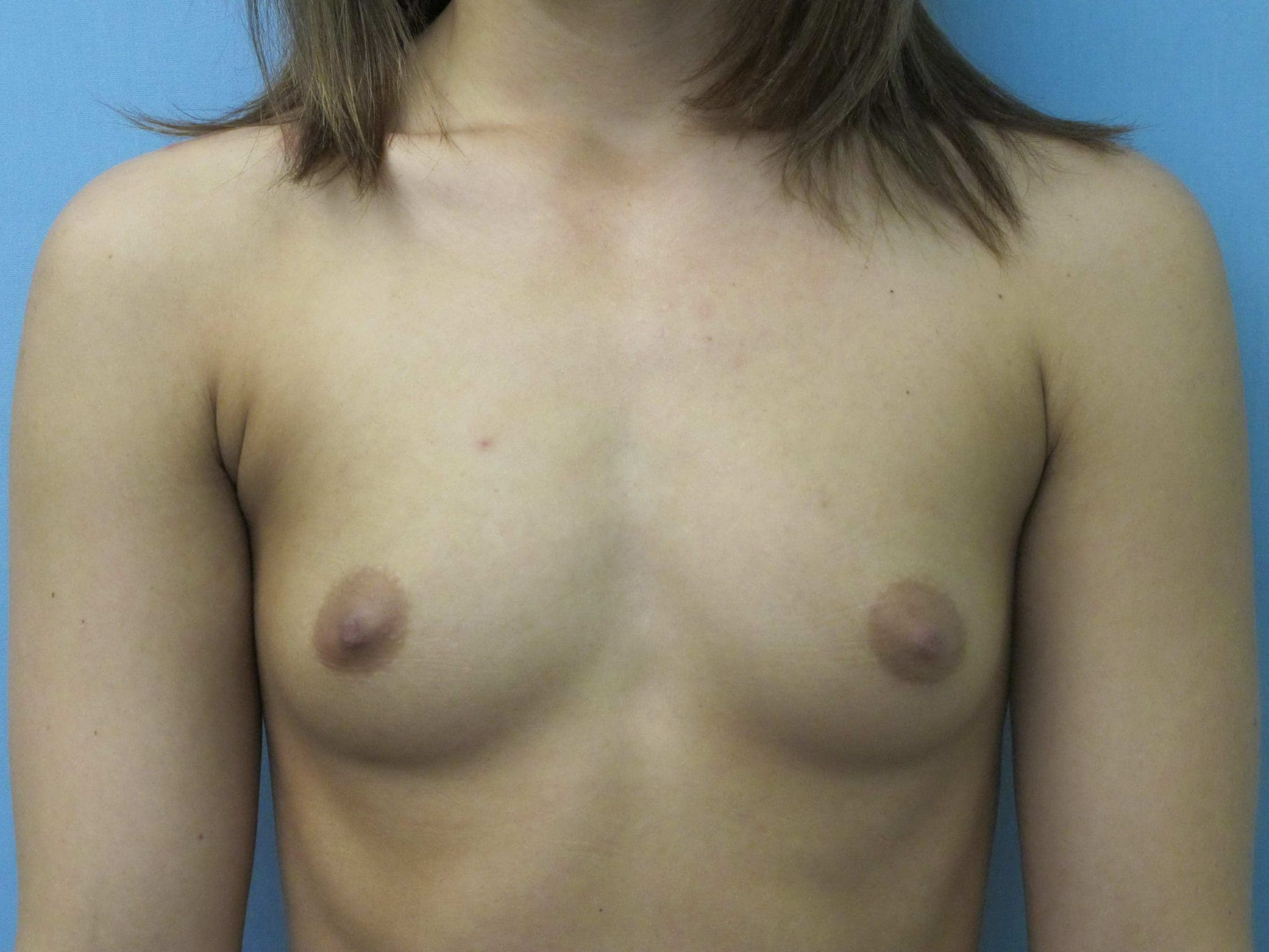 Breast Augmentation Patient Photo - Case 134 - before view-