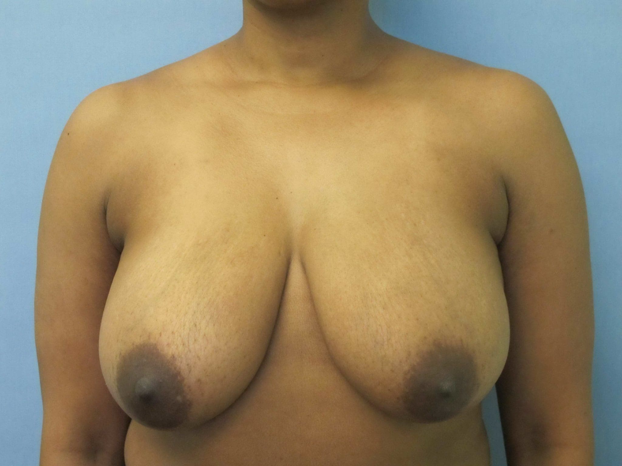 Breast Reduction Patient Photo - Case 141 - before view-