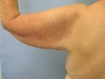 Liposuction - Case 77 - Before