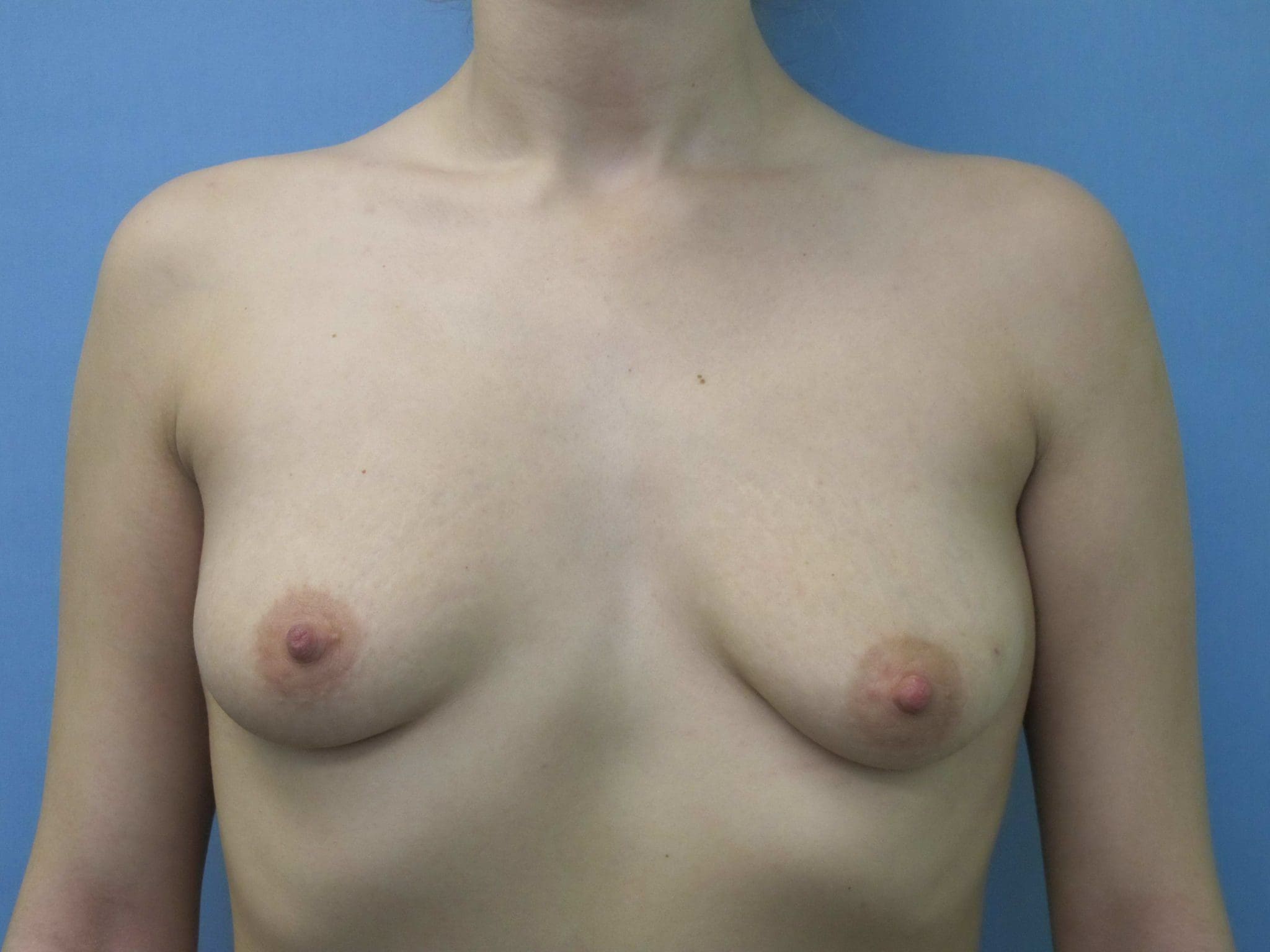 Breast Augmentation Patient Photo - Case 128 - before view-