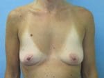 Breast Augmentation - Case 142 - Before