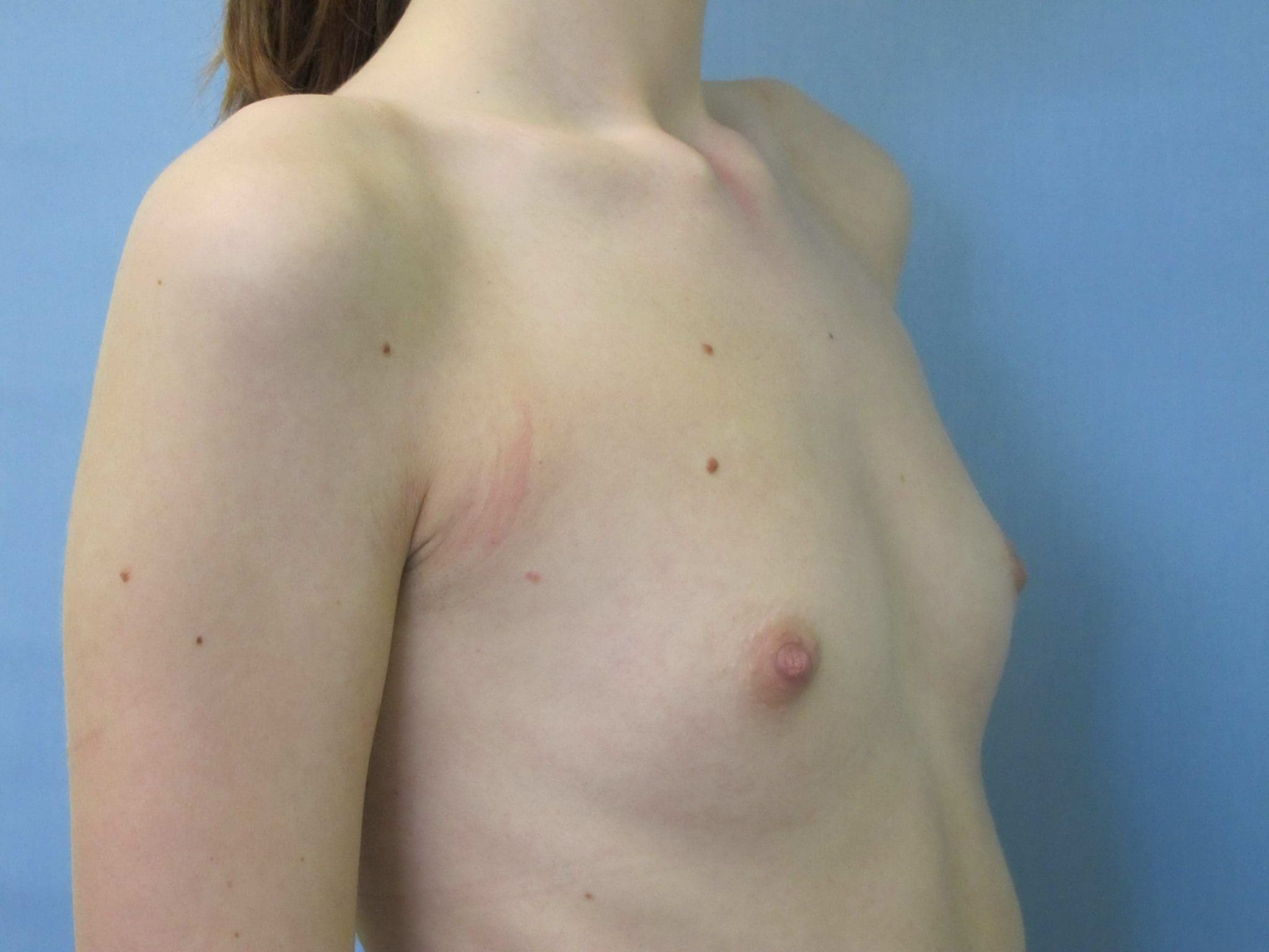 Breast Augmentation Patient Photo - Case 131 - before view-2