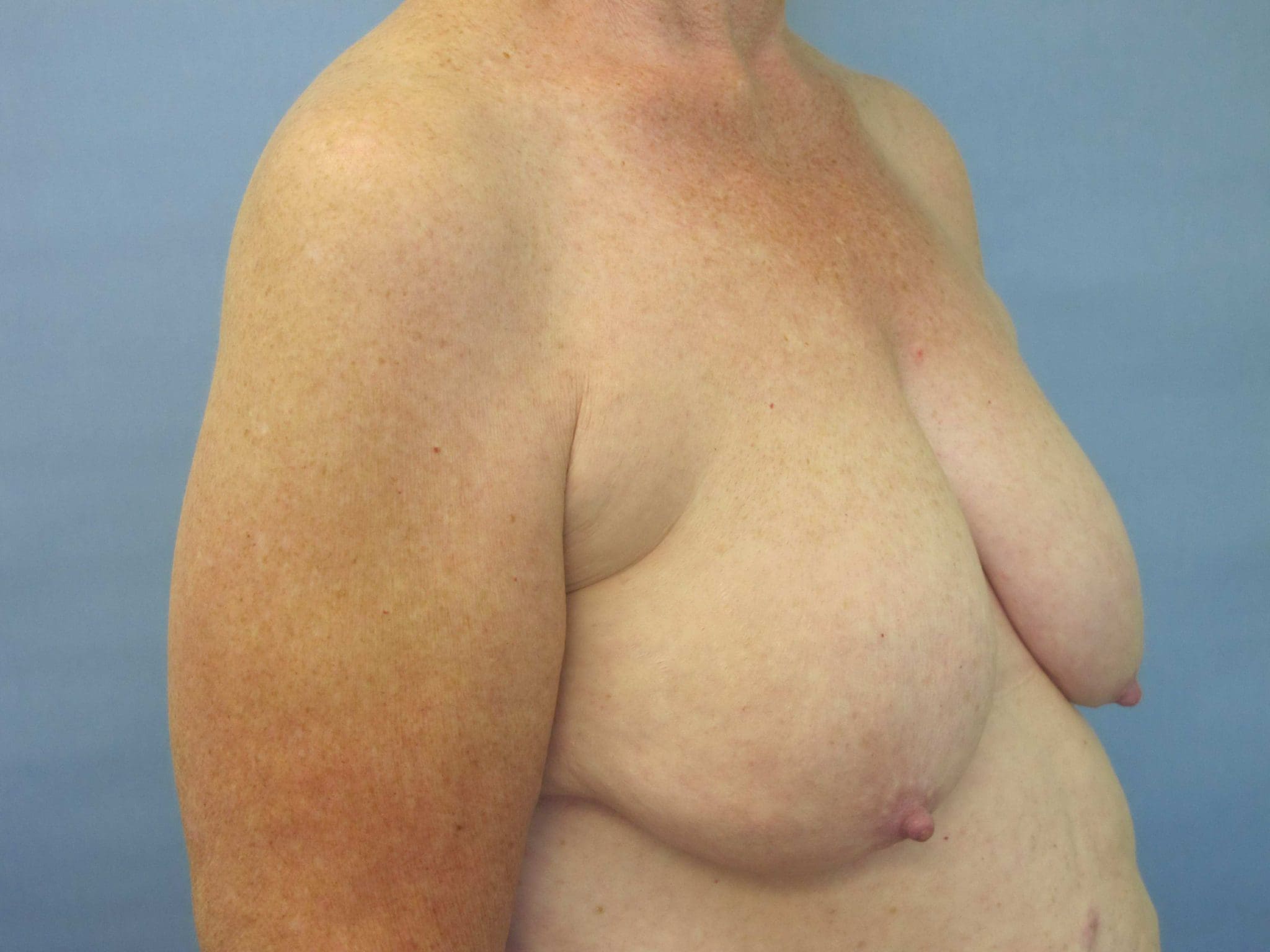 Breast Reduction Patient Photo - Case 72 - before view-1