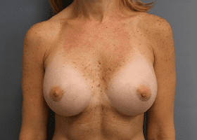 Breast Augmentation Patient Photo - Case 167 - after view