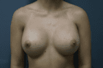 Breast Augmentation - Case 164 - After